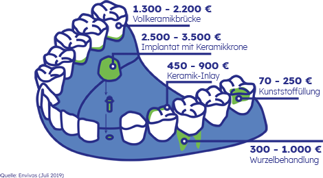 Eine Grafik zeigt die Kosten für verschiedene Zahnbehandlungen, die eine Zahnzusatzversicherung übernimmt.