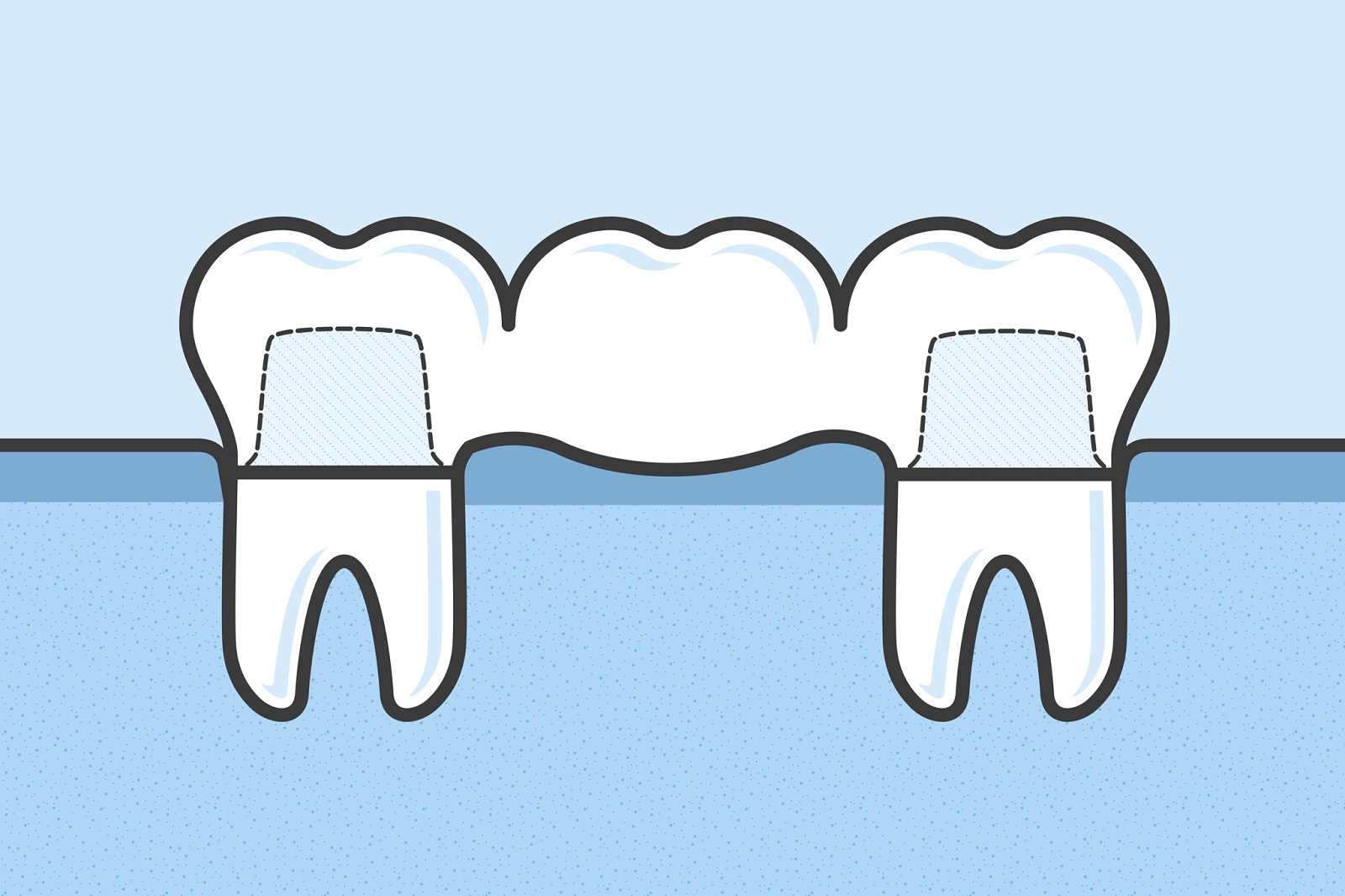 Die Grafik zeigt, wie eine Zahnbrücke von zwei Pfeilerzähnen gehalten wird.