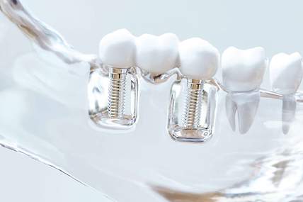 Das Bild zeigt Zahnimplantate, die dank Zahnzusatzversicherung als Zahnersatz realisiert werden können. 
