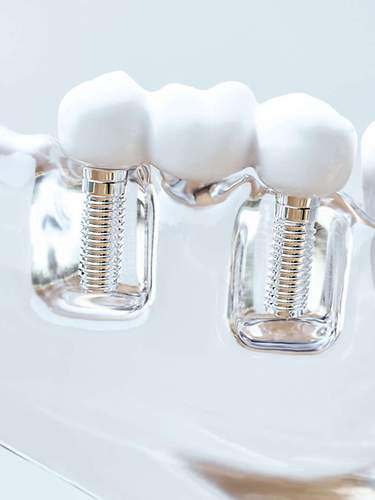 Das Bild zeigt Zahnimplantate, die dank Zahnzusatzversicherung als Zahnersatz realisiert werden können. 